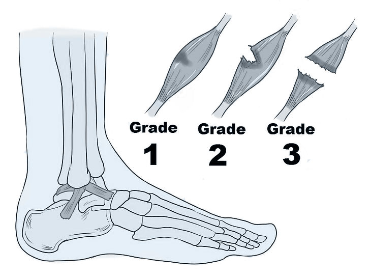 entorse de cheville : quelle gravité