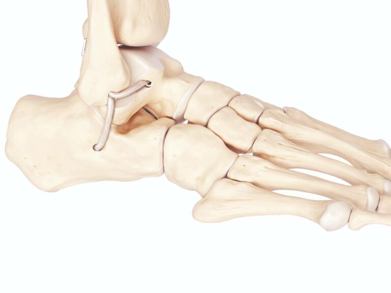 reconstruction arthroscopique des ligaments latéraux de la cheville