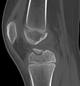 radiographie du genou avec une fracture des épines tibiales