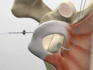 Latarjet sous arthroscopie