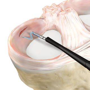 suture méniscale technique All Inside Arthrex Meniscal Cinch II