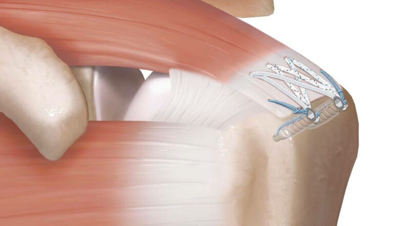réparation arthroscopique des tendons de la coiffe des rotateurs sans nœud (technique SpeedBridge™)